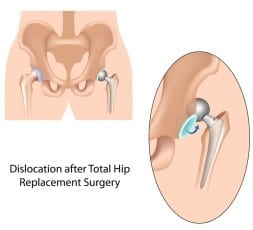 defective-hip-replacement