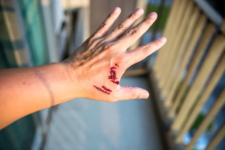 dog bite