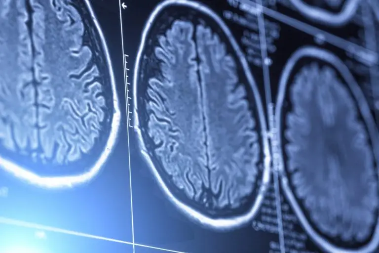 Brain scans showing traumatic brain injuries.