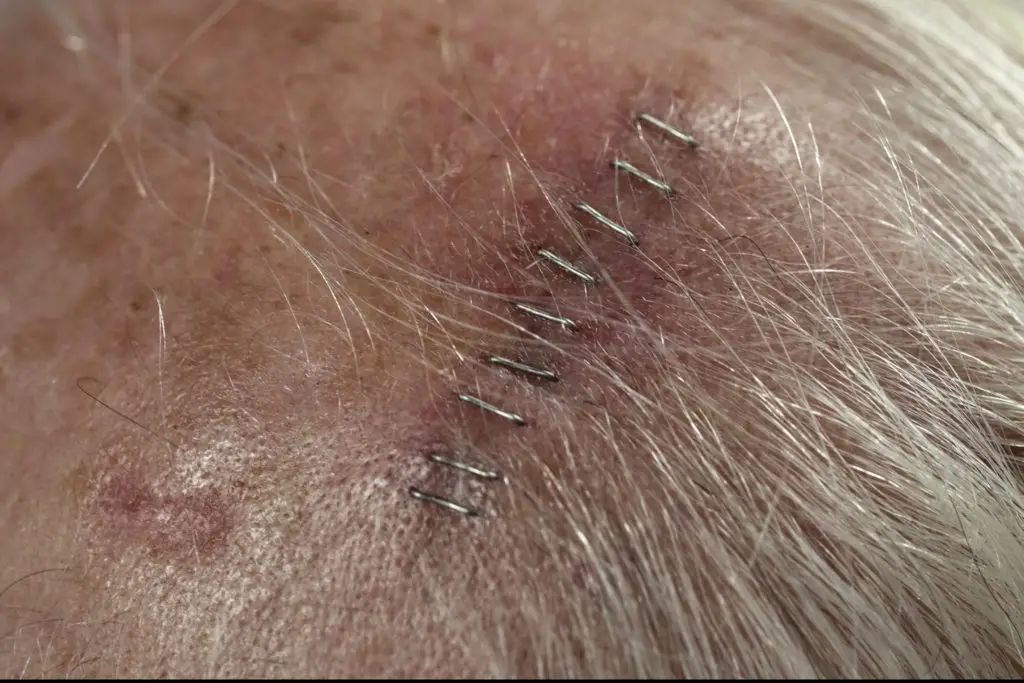 Surgical Staplers Recalled After Death and Serious Injuries