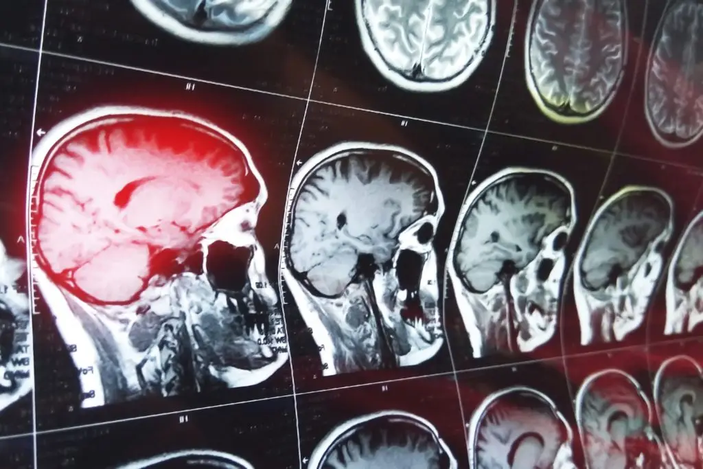 Study Shows Recovering from a Concussion Could Take Longer Than Expected