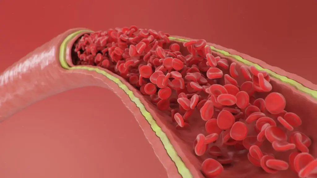 Ovation Abdominal Stent Graft Recalled After Five Patient Deaths