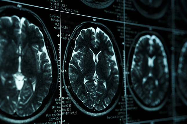 X-Ray scan of brain injury.