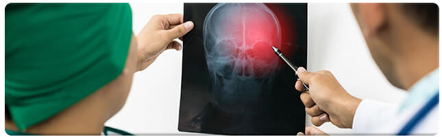 anaheim brain injury lawyers