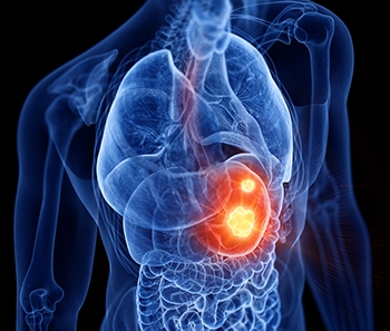 A 3D view of a body with stomach cancer; one of the dangerous side effects of using Zantac or ranitidine.