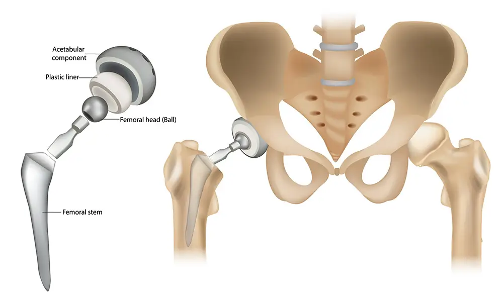 How a hip replacement implant works