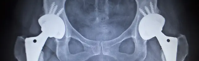 Hip replacement lawyer