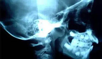 brain injury lawyers