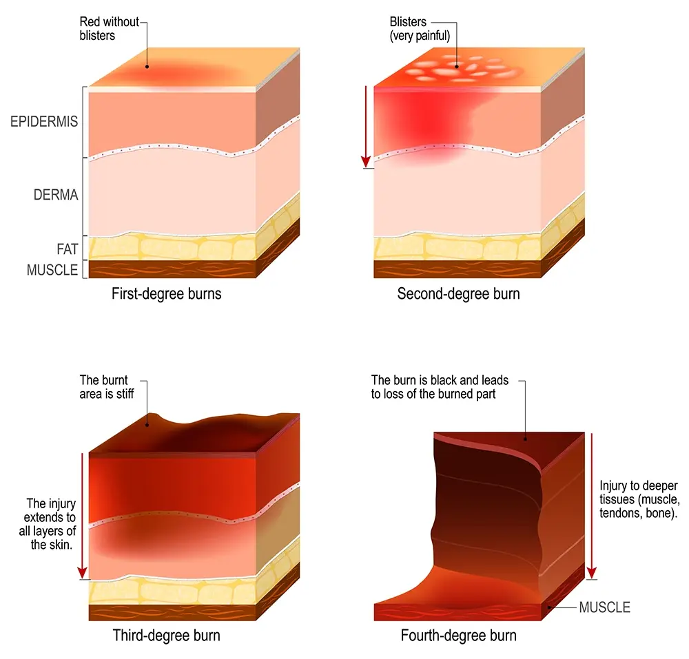Graphics showing a dissected view of a first-degree burn, second-degree burn- third-degree burn, and fourth-degree burn.