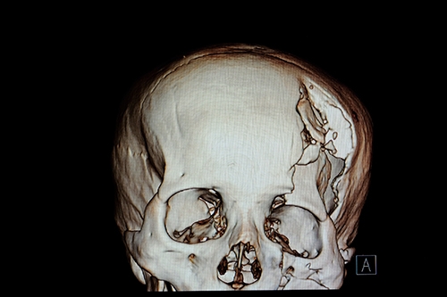 X-Ray of a skull fracture.