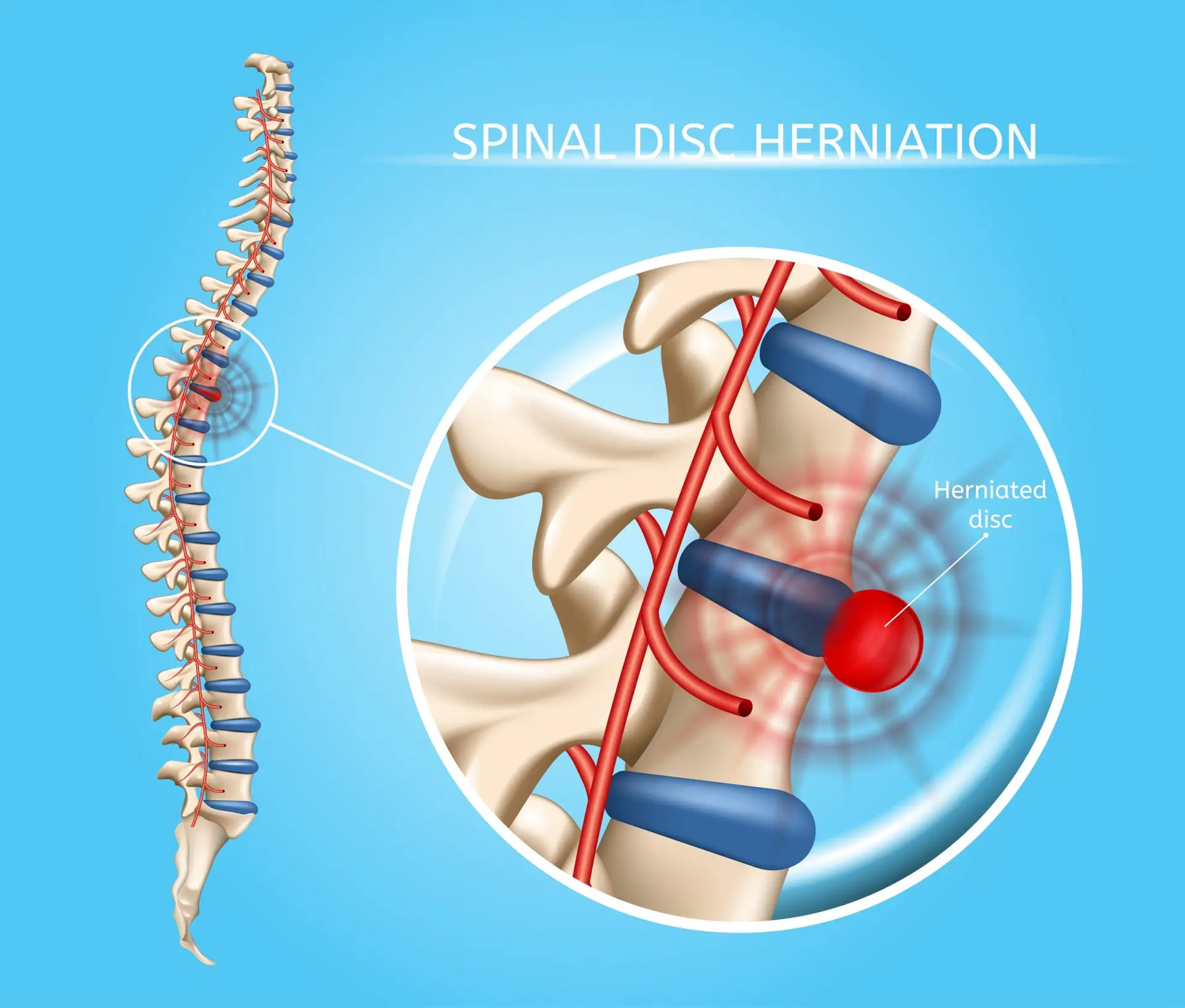 A graphic showing a herniated disc back injury
