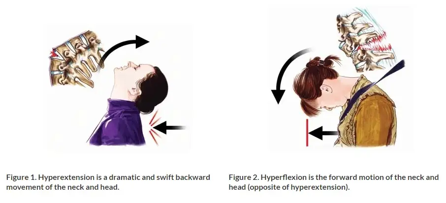 A graphic showing how whiplash injuries occur.
