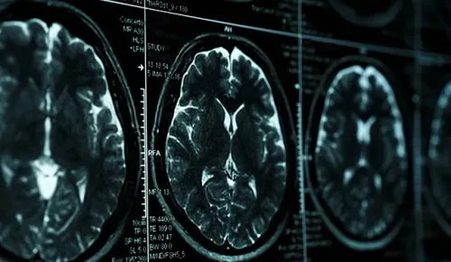 brain injuries shown on a CT scan